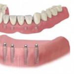 Phục hình thẩm mỹ với Implant