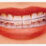 Niềng răng thẩm mỹ mắc cài sứ