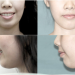 Những điều cần biết trước khi niềng răng hô