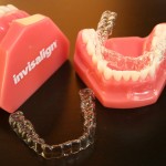 Niềng răng cho trường hợp móm