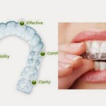 Giải quyết vấn đề hô móm với niềng răng