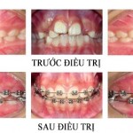 Làm đẹp cùng mắc cài niềng răng