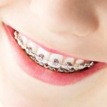 Có nên cho trẻ niềng răng ?