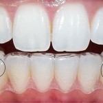 Niềng răng có đau không ?