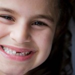 Niềng răng không mắc cài Invisalign có đau không ?