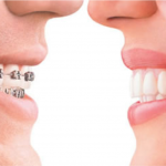 Niềng răng thưa giá bao nhiêu tiền ?