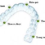 Không mắc cài khi niềng răng có hiệu quả thẩm mỹ không ?