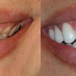 Tẩy trắng răng bị nhiễm tetracycline hiệu quả tại nha khoa