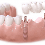 Thời gian bao lâu để hoàn thành trồng răng implant