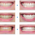 Nguyên nhân răng ố vàng và cách giải quyết