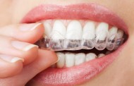 Loại bỏ răng úa vàng bằng phương pháp tẩy trắng