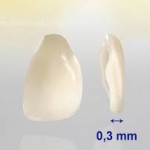 Răng sứ veneer như thế nào ?