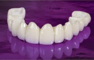 Tổng hợp thông tin về răng sứ titan