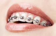 Những loại niềng răng mắc cài cố định