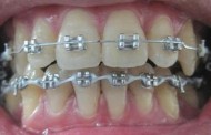 Niềng răng hô giúp mọi người có hàm răng đẹp