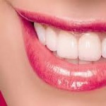 Quy trình bọc răng sứ titan như thế nào ?