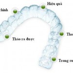 Tại sao niềng răng invisalign có chi phí cao?