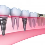 Cấy ghép Implant có xảy ra nguy hiểm gì không ?