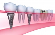 Cấy ghép Implant có xảy ra nguy hiểm gì không ?
