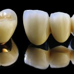 Trồng răng sứ titan thẩm mỹ