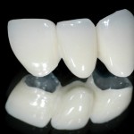 Ưu điểm của răng sứ Zirconia