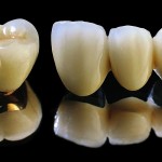 Bọc răng sứ titan tạo tính thẩm mỹ