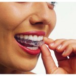 Những câu hỏi hay gặp khi niềng răng