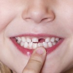 Nguyên nhân mất răng và cách phục hình