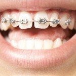 Niềng răng thưa trong bao lâu ?