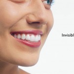 Quy trình niềng răng bằng khay Invisalign