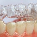 Ưu điểm của phương pháp niềng răng thẩm mỹ Invisalign