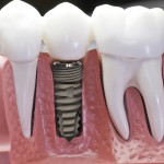 Ai không nên cấy ghép implant ?