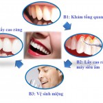 Có nên lấy cao răng không ?