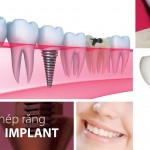 Phục hình răng Implant 4S giá bao nhiêu ?