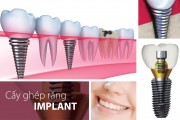 Phục hình răng Implant 4S giá bao nhiêu ?