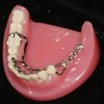 Phương pháp trồng răng Implant cho người cao tuổi