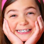 Niềng răng hô như thế nào ?