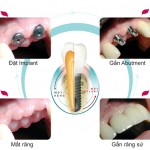 Cấy ghép răng implant ở đâu tốt ?