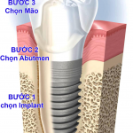 Cấy ghép răng implant ở đâu tốt ?