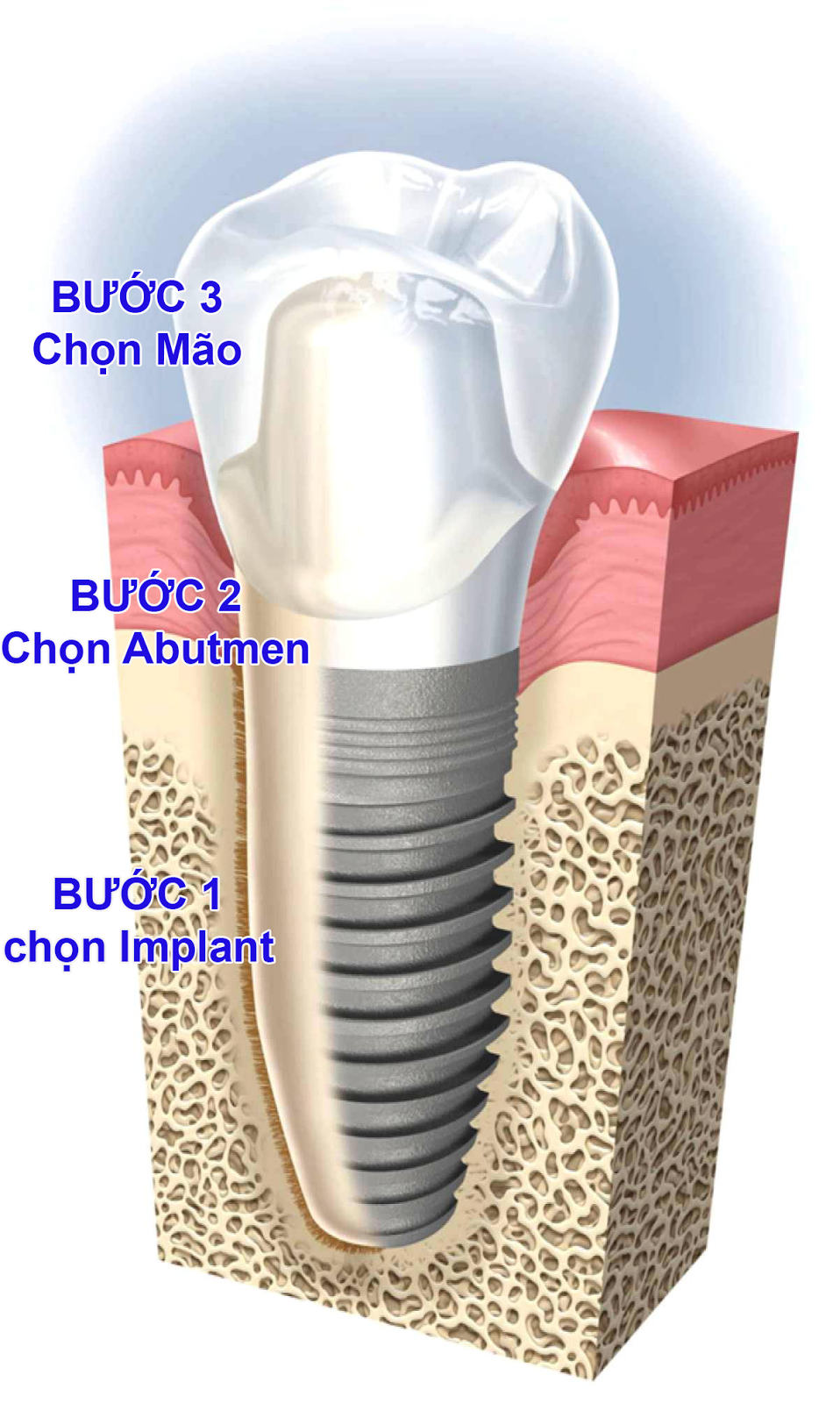 Cấy ghép răng implant ở đâu tốt ?