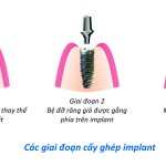 Tiêu xương khi mất răng và ghép xương