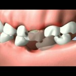 Răng khôn mọc xiên