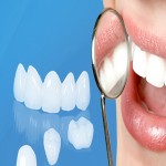 Răng sứ Venus có tốt không ?