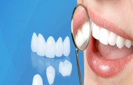 Răng sứ Venus có tốt không ?