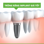 Ca cấy ghép implant giá bao nhiêu ?