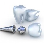 Chi phí cấy ghép răng implant giá bao nhiêu ?