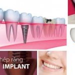 Trồng răng Implant cho người cao tuổi