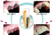 Implant dùng được bao lâu ?