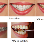Niềng răng mắc cài tự đóng