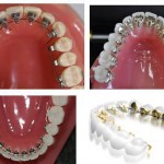 Niềng răng mắc cài mặt lưỡi tại thành phố Hồ Chí Minh